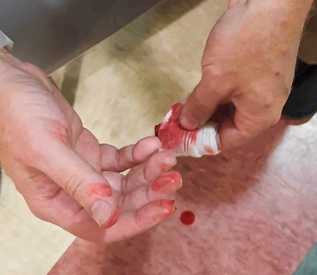 Cut finger from rotary cutter