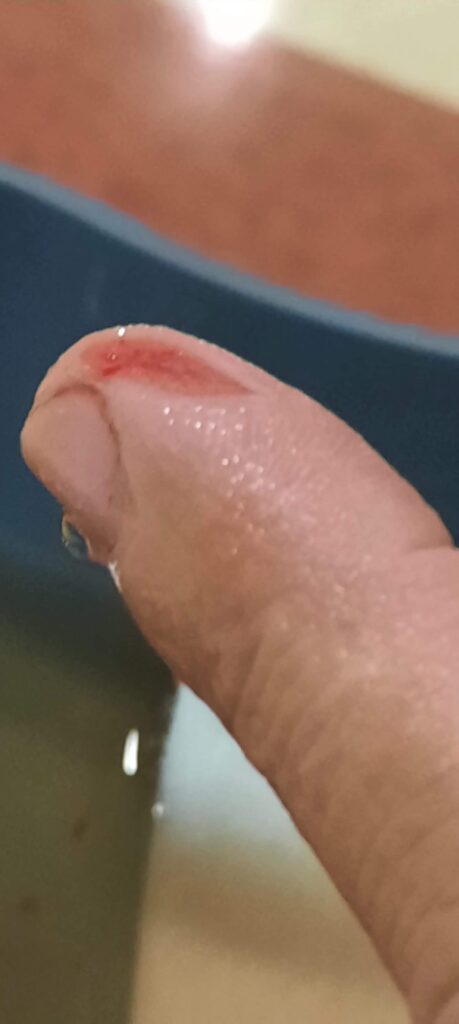 Cut finger from rotary cutter