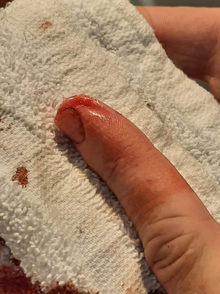Cut finger from rotary cutter