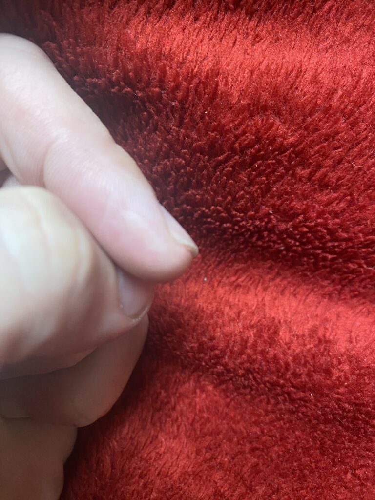 Scar on finger one year after rotary cutter cut my finger 